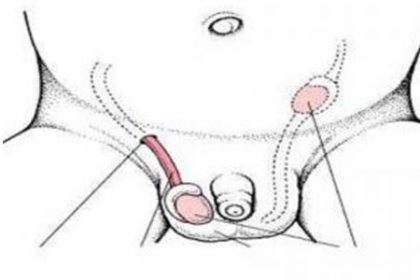 İnmemiş Testis